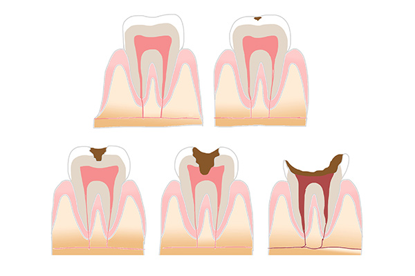 虫歯の治療方法