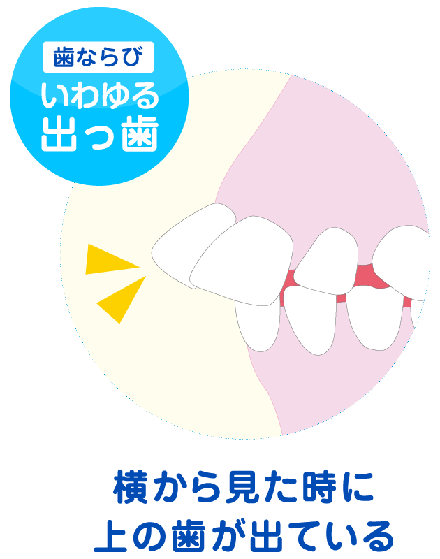 姫路市 Himeji Olivier Dental Clinic 小児矯正 出っ歯